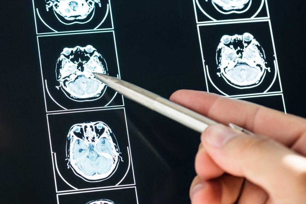 Brain Injury